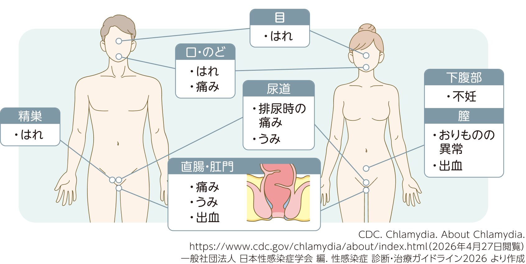 クラミジア感染症の症状部位マップ。目のはれ、口・のどのはれや痛み、尿道の排尿時の痛みやうみ、直腸・肛門の痛み・うみ・出血、精巣のはれ（男性）、下腹部の不妊や膣のおりものの異常・出血（女性）が起こりうる。