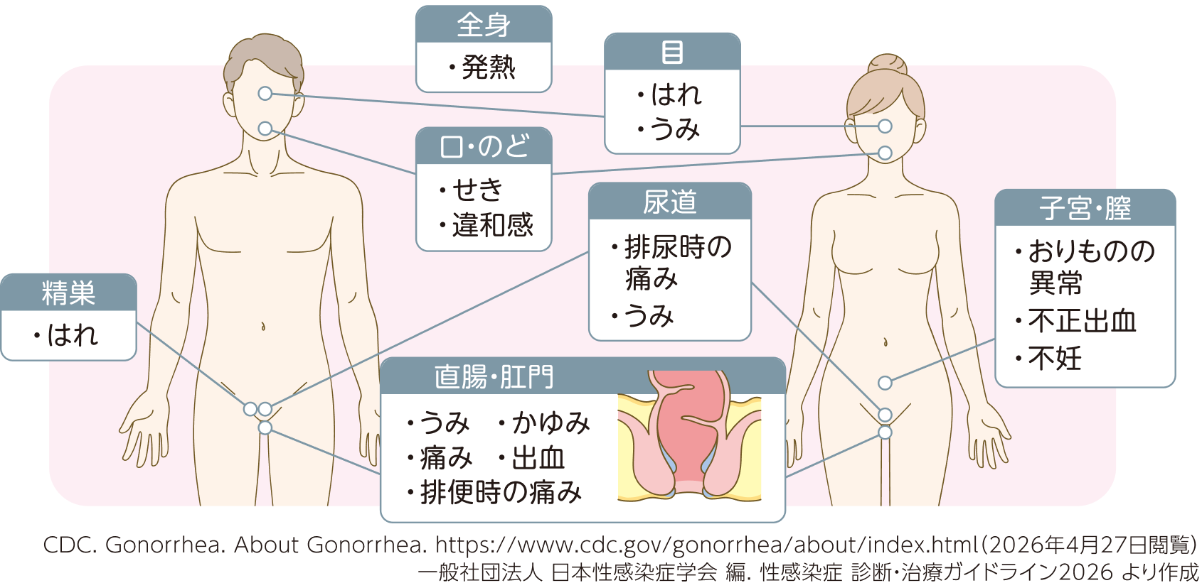 淋菌感染症の症状部位マップ。全身の発熱、目のはれ・うみ、口・のどのせき・違和感、尿道の排尿時の痛みやうみ、直腸・肛門のうみ・かゆみ・痛み・出血・排便時の痛み、精巣のはれ（男性）、子宮・膣のおりものの異常・不正出血・不妊（女性）が起こりうる。