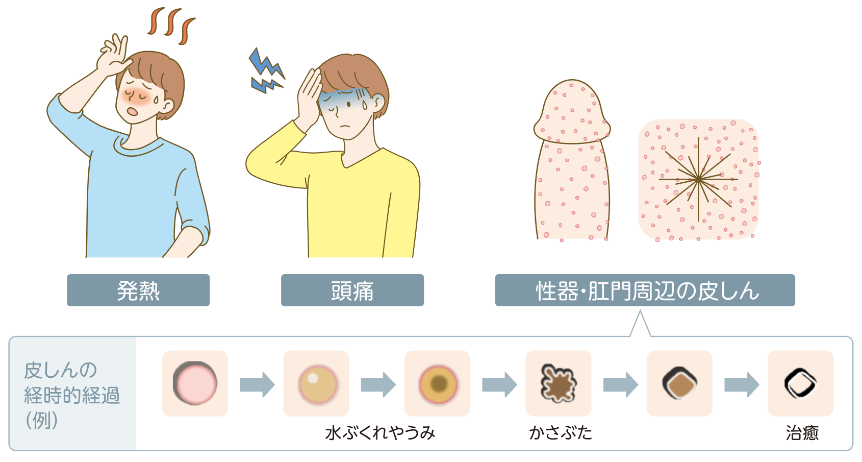 エムポックス（mpox）の主な症状。発熱、頭痛、性器・肛門周辺の皮しん。皮しんは紅斑から水ぶくれやうみ、かさぶたを経て治癒するまでの経過を6段階のイラストで示している。