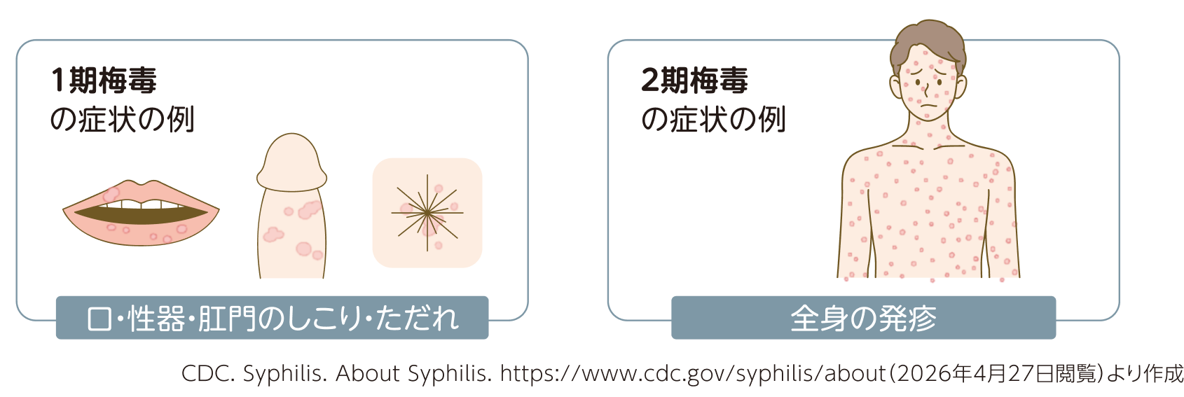 1期梅毒と2期梅毒の症状の例。1期は口・性器・肛門のしこりやただれ、2期は全身の発疸が特徴。